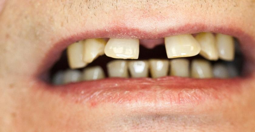 Investigación U. de Chile identifica el proceso de muerte celular que ocurre en la progresión de la periodontitis