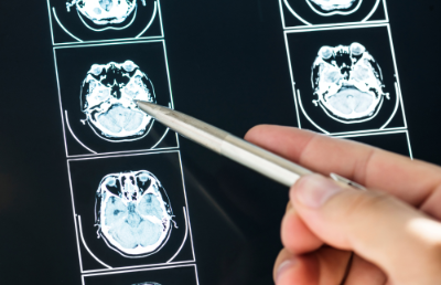 Una de las investigaciones busca indagar sobre los síntomas cognitivos provocados en pacientes con esquizofrenia, tales como déficits en memoria, atención, velocidad de procesamiento y funciones ejecutivas.
