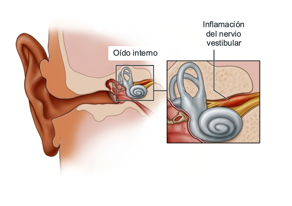 Neuronitis ¿Qué es la neuronitis vestibular? Especialista explica cuáles son sus ...